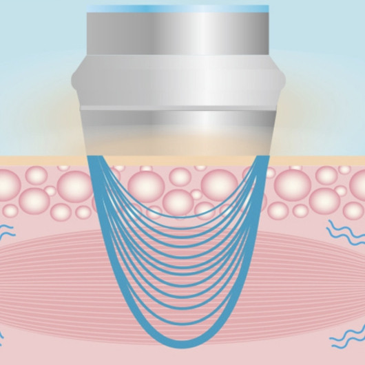 Апарат фонофорезу Н3234 - для обличчя і тіла з електрокоагулятором - Зображення 6